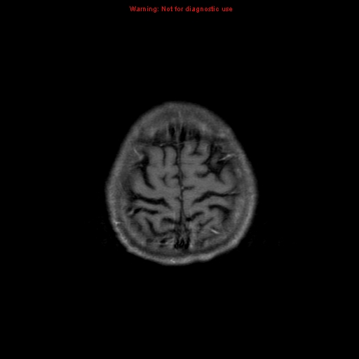 File:Cerebral and orbital tuberculomas (Radiopaedia 13308-13311 Axial T1 C+ 19).jpg