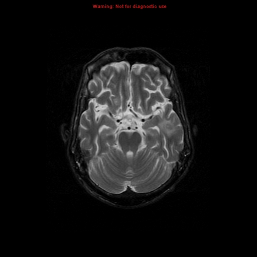 File:Cerebral and orbital tuberculomas (Radiopaedia 13308-13311 Axial T2 8).jpg