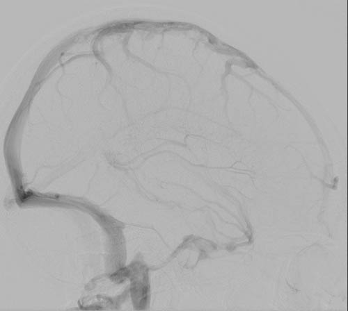 File:Cerebral angiographic projections (Radiopaedia 46308-50712 H 1).jpg