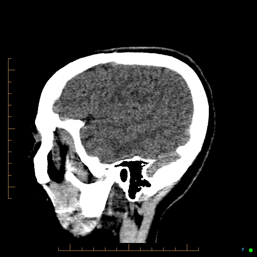 Cerebral arteriovenous malformation (AVM) (Radiopaedia 78162-90706 A 63).jpg