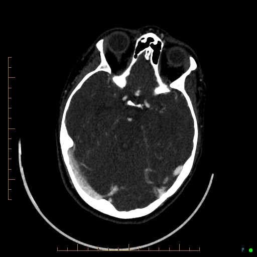Cerebral arteriovenous malformation (AVM) (Radiopaedia 78162-90706 Axial CTA 108).jpg