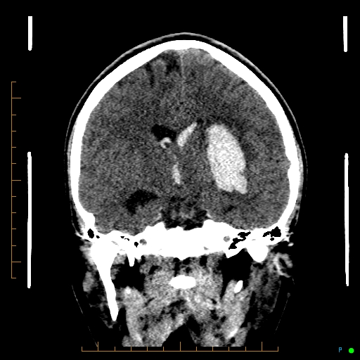 File:Cerebral arteriovenous malformation (AVM) (Radiopaedia 78162-90706 Coronal non-contrast 50).jpg