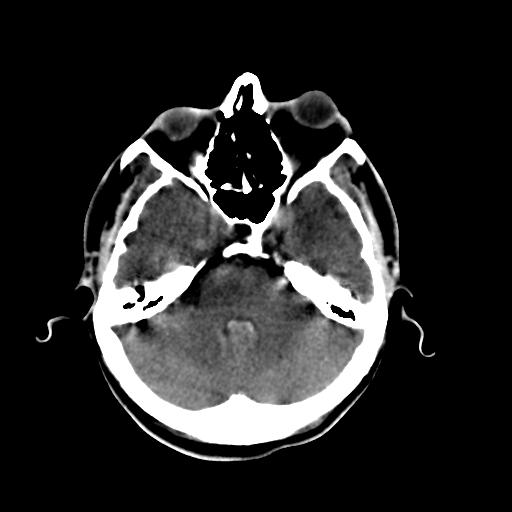 Cerebral arteriovenous malformation (Radiopaedia 28518-28759 Axial non-contrast 19).jpg