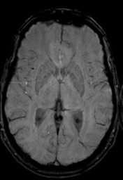 File:Cerebral arteriovenous malformation (Radiopaedia 55798-62372 Axial SWI 20).png