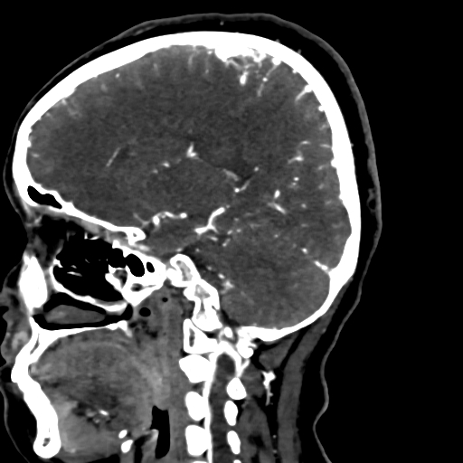 Cerebral arteriovenous malformation (Radiopaedia 73830-84645 Sagittal C+ delayed 55).jpg