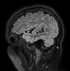Cerebral arteriovenous malformation (Radiopaedia 74411-85654 Sagittal FLAIR 23).jpg