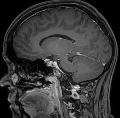 Cerebral arteriovenous malformation (Radiopaedia 74411-85654 Sagittal T1 C+ 56).jpg