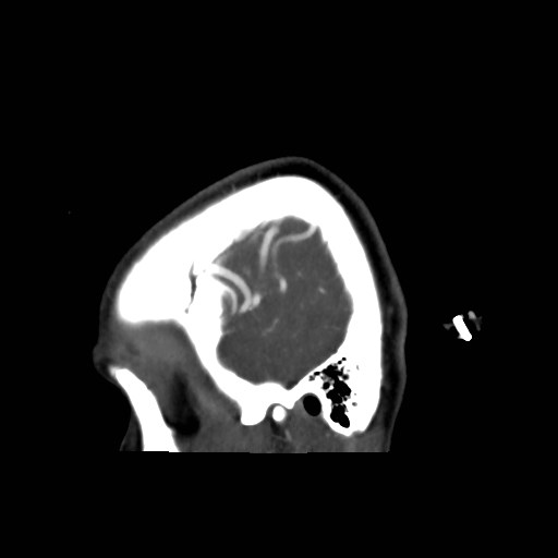 File:Cerebral arteriovenous malformation (Radiopaedia 79677-92888 C 1).jpg