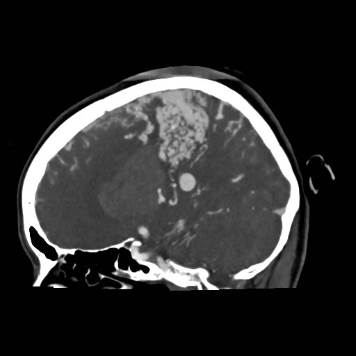 File:Cerebral arteriovenous malformation (Radiopaedia 79677-92888 C 14).jpg