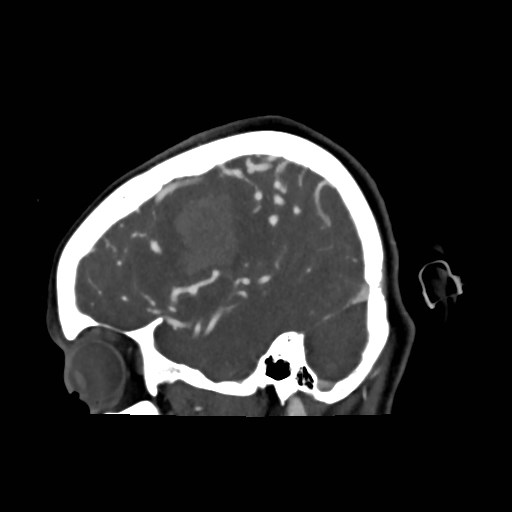 File:Cerebral arteriovenous malformation (Radiopaedia 79677-92888 C 6).jpg