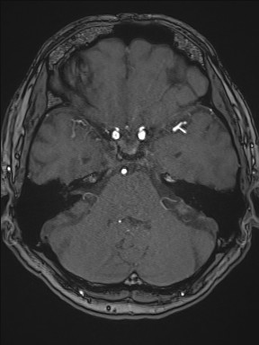 Cerebral arteriovenous malformation (Radiopaedia 84015-99245 Axial TOF 85).jpg