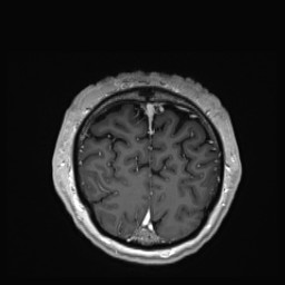 Cerebral arteriovenous malformation (Radiopaedia 84015-99245 Coronal T1 C+ 149).jpg