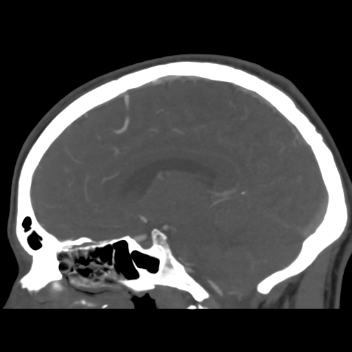 Cerebral arteriovenous malformation (Spetzler-Martin grade 2) (Radiopaedia 41262-44076 G 26).png