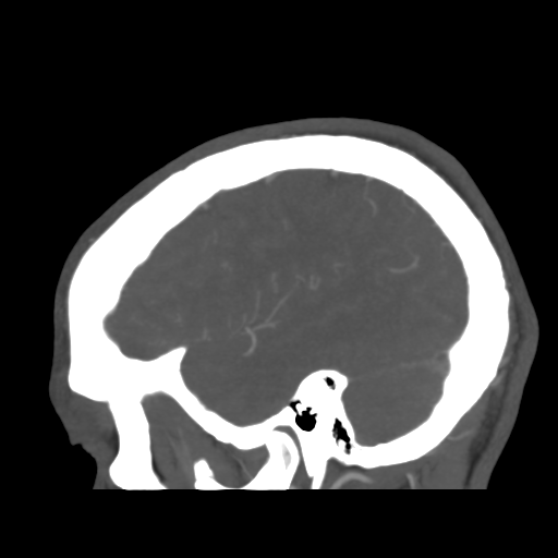 Cerebral arteriovenous malformation (Spetzler-Martin grade 2) (Radiopaedia 41262-44076 G 43).png