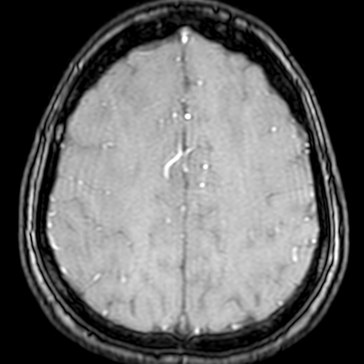 Cerebral arteriovenous malformation at posterior body of corpus callosum (Radiopaedia 74111-84925 Axial MRA 171).jpg