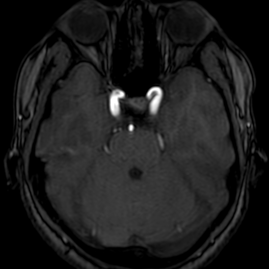 Cerebral arteriovenous malformation at posterior body of corpus callosum (Radiopaedia 74111-84925 Axial MRA 61).jpg