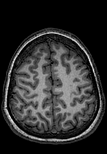 Cerebral arteriovenous malformation at posterior body of corpus callosum (Radiopaedia 74111-84925 Axial T1 57).jpg