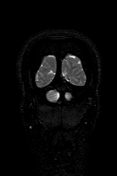 Cerebral arteriovenous malformation at posterior body of corpus callosum (Radiopaedia 74111-84925 Coronal T2 170).jpg