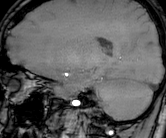 Cerebral arteriovenous malformation at posterior body of corpus callosum (Radiopaedia 74111-84925 J 257).jpg