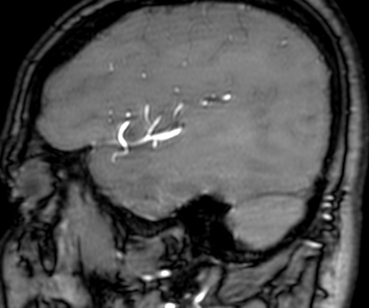 Cerebral arteriovenous malformation at posterior body of corpus callosum (Radiopaedia 74111-84925 J 65).jpg