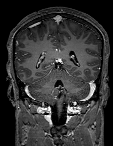 Cerebral arteriovenous malformation at posterior body of corpus callosum (Radiopaedia 74111-84925 K 250).jpg