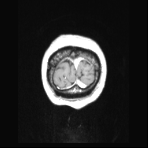 Cerebral arteriovenous malformation with hemorrhage (Radiopaedia 34422-35737 Coronal T1 C+ 7).png