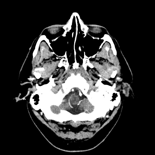 Cerebral arteriovenous malformation with lobar hemorrhage (Radiopaedia 35598-57216 A 7).jpg