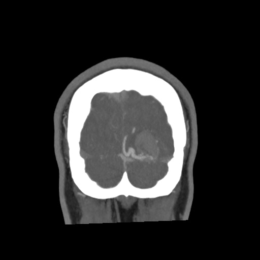 Cerebral arteriovenous malformation with lobar hemorrhage (Radiopaedia 35598-57216 C 85).jpg