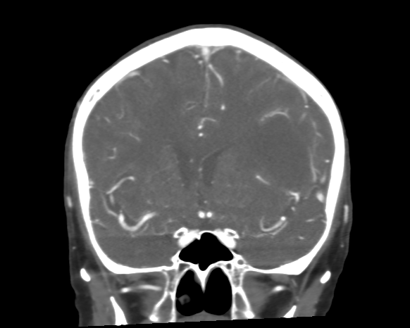 File:Cerebral arteriovenous malformation with lobar hemorrhage (Radiopaedia 44725-48511 A 24).png