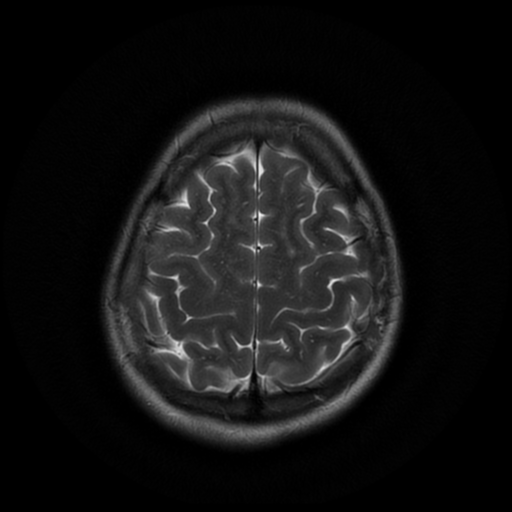 File:Cerebral autosomal dominant arteriopathy with subcortical infarcts and leukoencephalopathy (CADASIL) (Radiopaedia 41018-43768 Ax T2 PROP 17).png