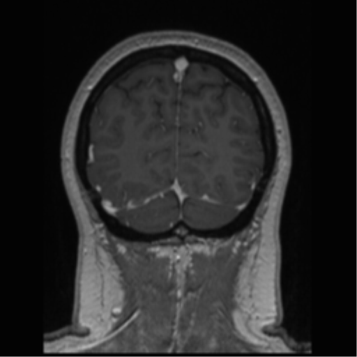 Cerebral cavernoma and development venous anomaly (Radiopaedia 37603-39482 Coronal T1 C+ 18).png