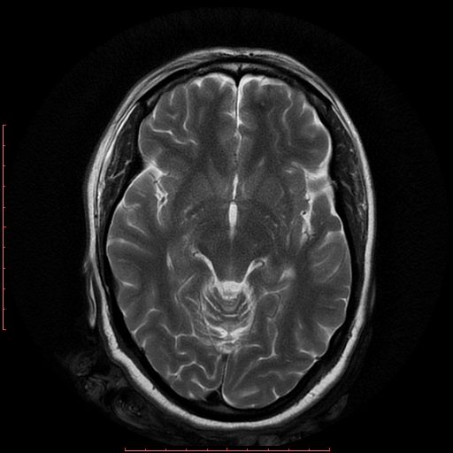File:Cerebral cavernous malformation (Radiopaedia 26177-26306 Axial T2 10).jpg