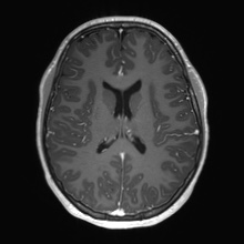Cerebral cavernous venous malformation (Radiopaedia 70008-80021 Axial T1 C+ 46).jpg
