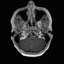 Cerebral cavernous venous malformation (Radiopaedia 70008-80021 Axial T1 C+ 8).jpg