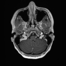 Cerebral cavernous venous malformation (Radiopaedia 70008-80021 Axial T1 C+ 9).jpg
