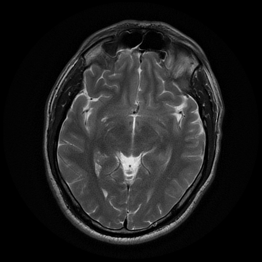 File:Cerebral cavernous venous malformation (Zabramski type II) (Radiopaedia 85511-101198 Axial T2 15).jpg