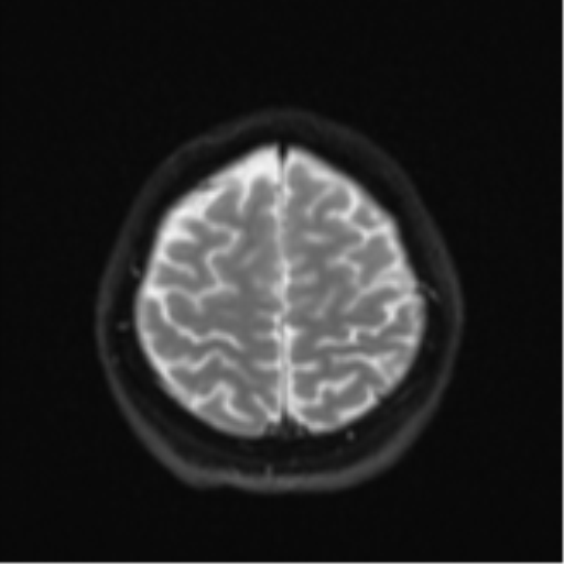 Cerebral cavernous venous malformations (Radiopaedia 48117-52946 Axial DWI 23).png