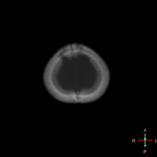 File:Cerebral contusion (Radiopaedia 48869-53911 Axial bone window 2).jpg