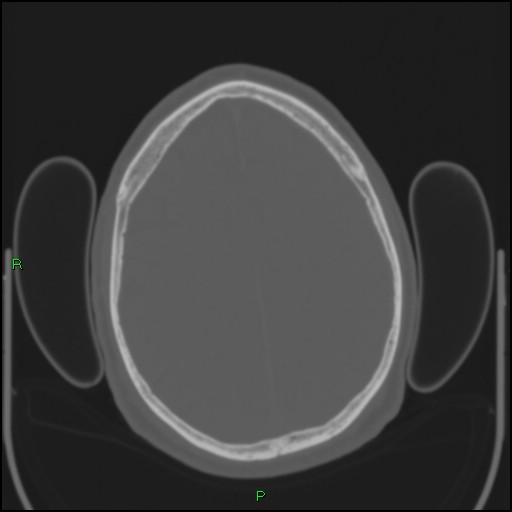 File:Cerebral contusions (Radiopaedia 33868-35039 Axial bone window 156).jpg