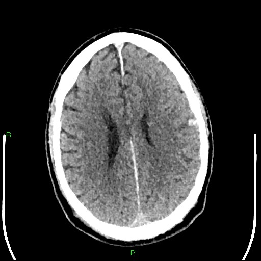 Cerebral contusions (Radiopaedia 33868-35039 Axial non-contrast 143).jpg