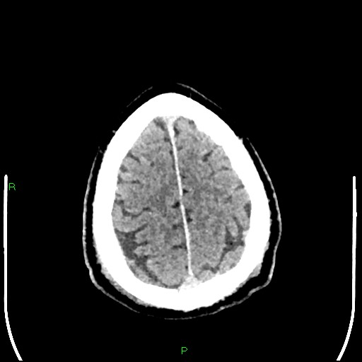 Cerebral contusions (Radiopaedia 33868-35039 Axial non-contrast 188).jpg