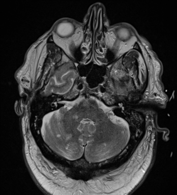 File:Cerebral embolic infarcts (embolic shower) (Radiopaedia 57395-64342 Axial T2 10).png
