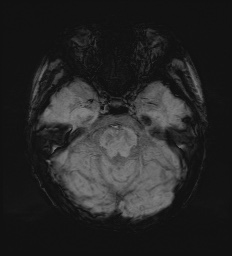 Cerebral embolic infarcts (embolic shower) (Radiopaedia 72391-82921 Axial SWI 24).jpg