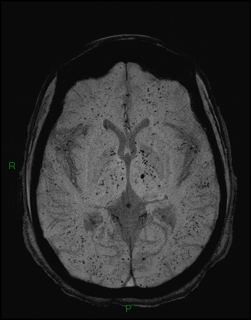 Cerebral fat embolism (Radiopaedia 35022-36525 Axial SWI 17).jpg