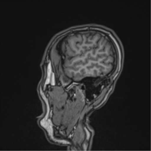 Cerebral fat embolism (Radiopaedia 57697-64639 Sagittal T1 41).png