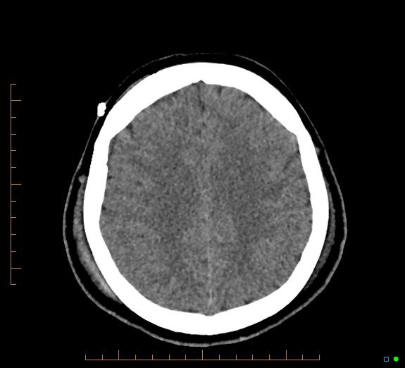 Cerebral fat embolism (Radiopaedia 85521-101224 Axial non-contrast 37).jpg