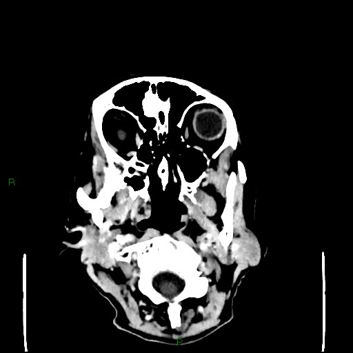 File:Cerebral metastases - breast primary (Radiopaedia 77653-89857 Axial C+ delayed 8).jpg