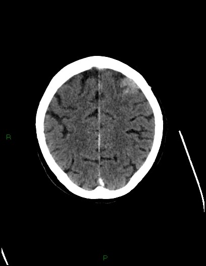 Cerebral metastases - ependymal and parenchymal (Radiopaedia 79877-93131 Axial C+ delayed 64).jpg
