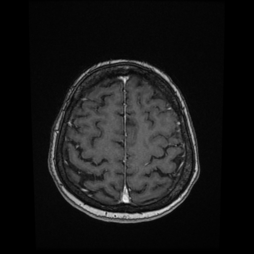 Cerebral metastases - melanoma (Radiopaedia 80972-94522 Axial T1 C+ 75).jpg