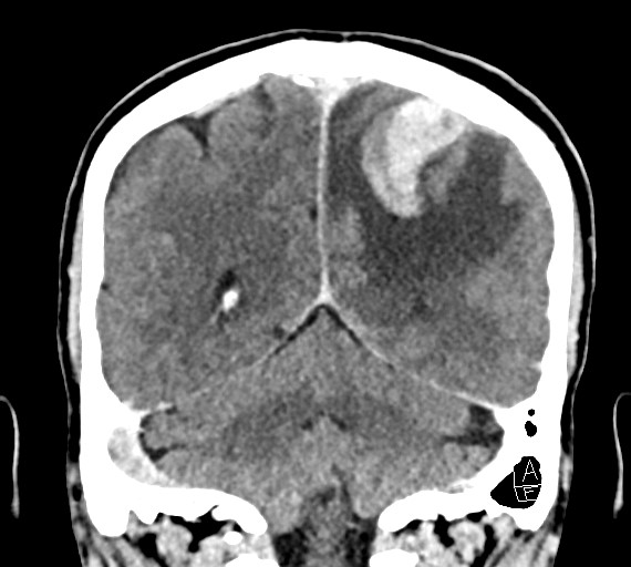 Cerebral metastases - testicular choriocarcinoma (Radiopaedia 84486-99855 D 44).jpg